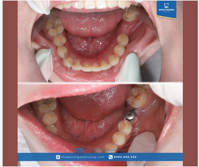 Phục hình răng hàm sớm có lợi như thế nào?