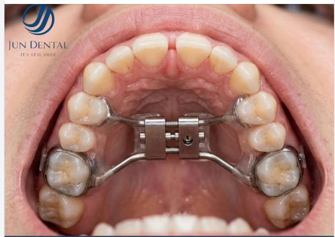 MỞ RỘNG CUNG HÀM – TẠO NỀN TẢNG CHO HÀM RĂNG CÂN ĐỐI