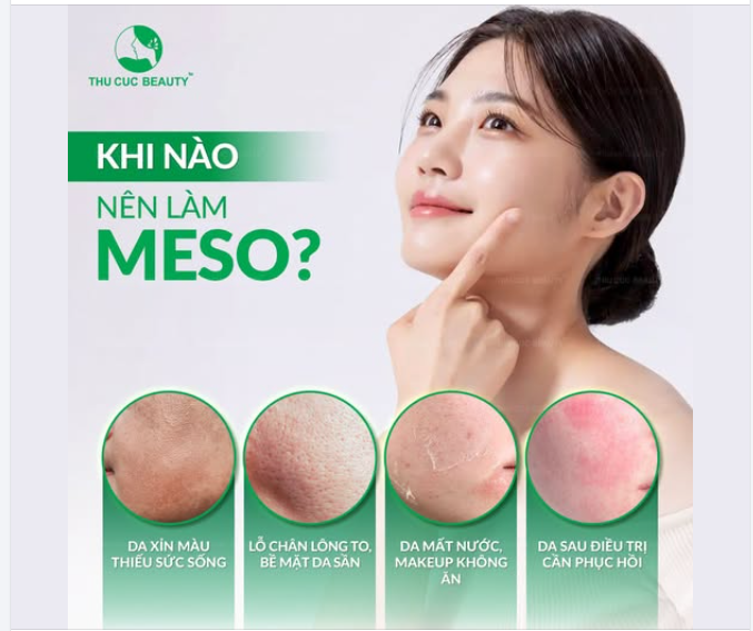 KHI NÀO NÊN LÀM MESO? ĐỌC NGAY POST NÀY NẾU BẠN CHƯA BIẾT!