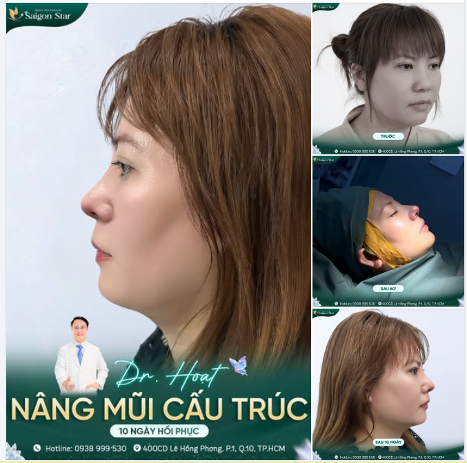 10 NGÀY HỒI PHỤC – MŨI XINH LÊN FORM, DIỆN MẠO THĂNG HẠNG!
