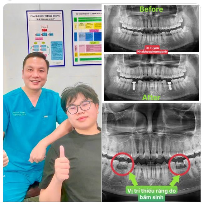 THIẾU RĂNG VĨNH VIỄN BẨM SINH: