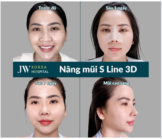 CẢI THIỆN 100% MŨI THẤP, ĐẦU MŨI TO VỚI NÂNG MŨI S LINE 3D CAO HÀI HOÀ, THANH THOÁT TẠI JW