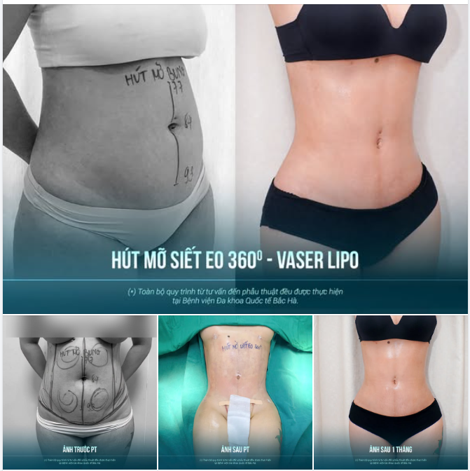 1 THÁNG SAU HÚT MỠ SIẾT EO 360 — VÒNG EO ĐÃ BẮT ĐẦU “LÊN NÉT”