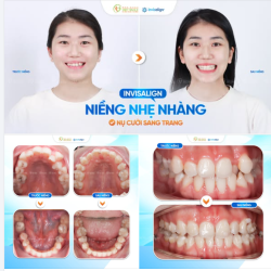 INVISALIGN NIỀNG NHẸ NHÀNG – NỤ CƯỜI SANG TRANG