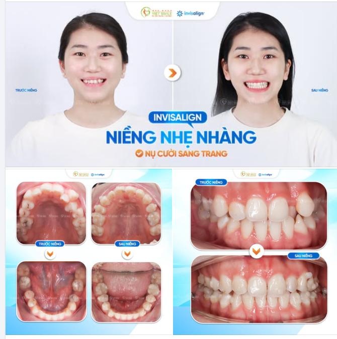 INVISALIGN NIỀNG NHẸ NHÀNG – NỤ CƯỜI SANG TRANG