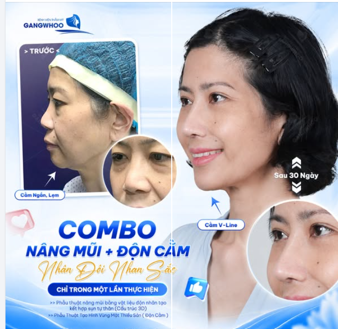 COMBO NÂNG MŨI + ĐỘN CẰM