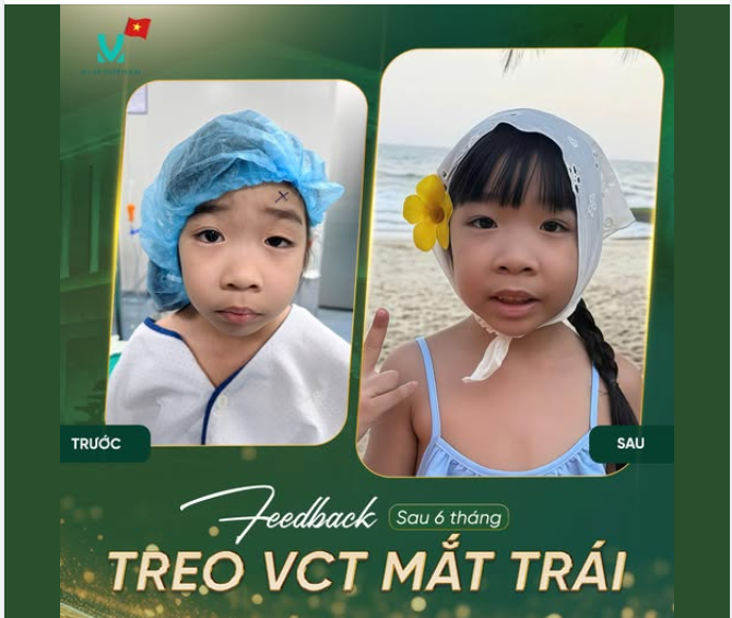FEEDBACK SAU 6 THÁNG TREO MI VCT MẮT TRÁI