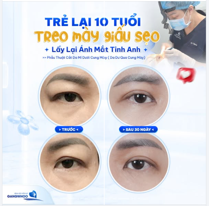 CẮT DA THỪA DƯỚI ĐƯỜNG CHÂN MÀY