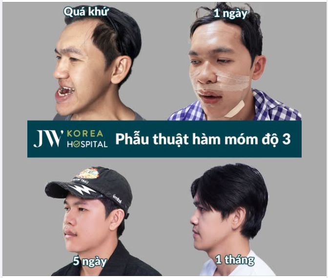 PHẪU THUẬT HÀM MẶT – HÀNH TRÌNH THAY ĐỔI DIỆN MẠO, MỞ RA MỘT CHƯƠNG MỚI CHO CUỘC ĐỜI