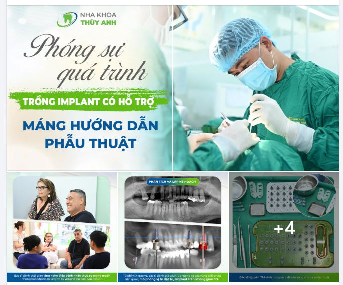 GHI LẠI QUÁ TRÌNH TRỒNG IMPLANT - KHÔI PHỤC CHỨC NĂNG ĂN NHAI CHO VỊ KHÁCH HÀNG TỚI TỪ AUSTRALIA