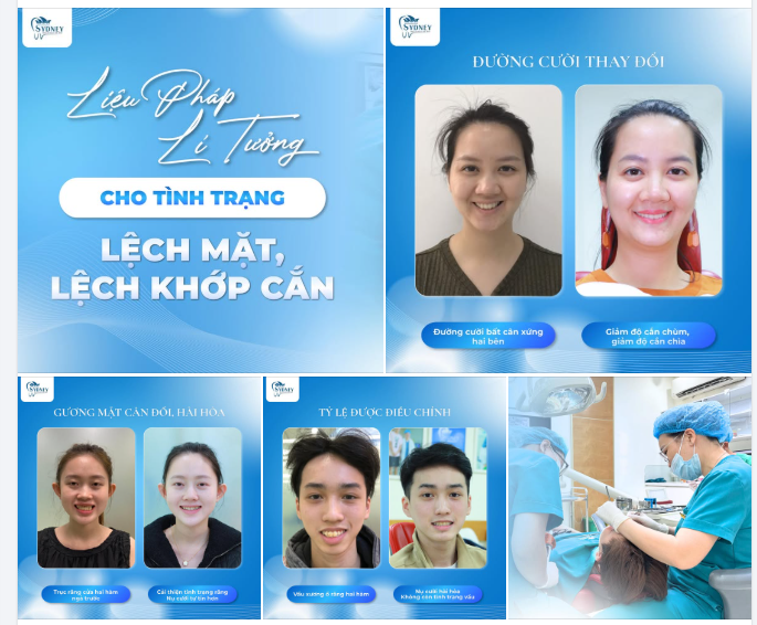 LIỆU PHÁP LÝ TƯỞNG CHO TÌNH TRẠNG LỆCH MẶT, LỆCH KHỚP CẮN