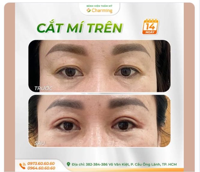 TRẺ TRUNG CHO ĐÔI MẮT - NHẸ NHÀNG CHO DIỆN MẠO