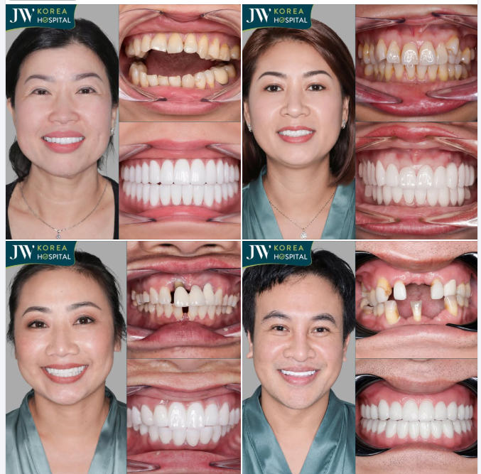 HƠN 1000+ NỤ CƯỜI TRẮNG SÁNG ĐƯỢC KIẾN TẠO THÀNH CÔNG VỚI BỌC RĂNG SỨ CHUẨN CHÂU ÂU TẠI JW