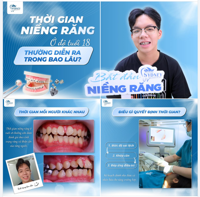 18 TUỔI: "CỘT MỐC VÀNG" ĐỂ F5 DIỆN MẠO - NIỀNG RĂNG MẤT BAO LÂU?