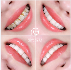 RĂNG SỨ LAVA ĐÁNH THỨC NỤ CƯỜI “NGỦ QUÊN”