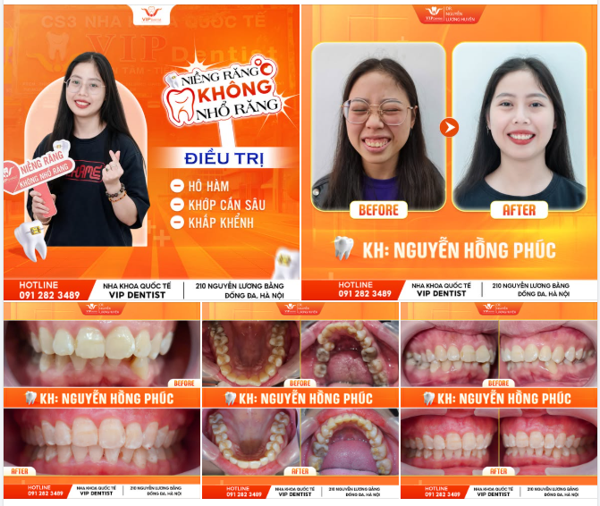 "SỢ NHỔ RĂNG" – VÀ CÁI KẾT BẤT NGỜ TẠI VIP DENTIST!