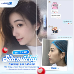 FEEDBACK SAU 2 NĂM SỬA MŨI LẠI