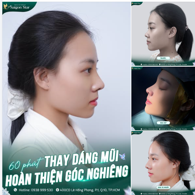 60 PHÚT HOÀN THIỆN GÓC NGHIÊNG CÙNG NÂNG MŨI CẤU TRÚC DR. HOẠT!!!