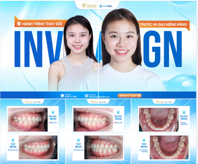 Hành trình chạm đến nụ cười tự tin cùng Invisalign