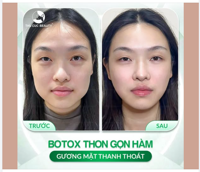 BOTOX THON GỌN HÀM - GƯƠNG MẶT THANH THOÁT, TỰ NHIÊN