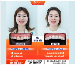 ĐÓNG KHE THƯA - CHỮA VIÊM LỢI