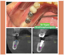 Sau khi cấy ghép implant cần kiêng gì?