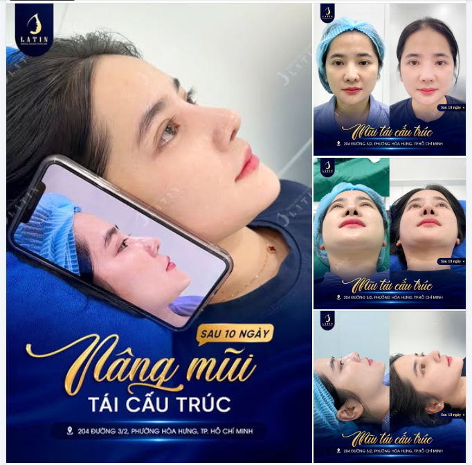 10 NGÀY “ĐIÊU KHẮC” LẠI GÓC NGHIÊNG – MŨI TÁI CẤU TRÚC VÀO DÁNG