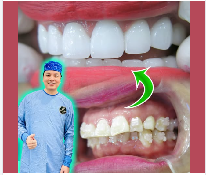 Cảm giác sau khi bọc răng sứ: Những điều bất thường cần lưu ý