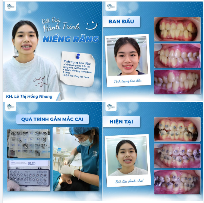 BẮT ĐẦU HÀNH TRÌNH NIỀNG RĂNG CÙNG CÔ BẠN HỒNG NHUNG