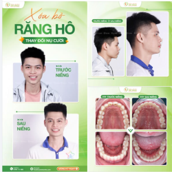 NIỀNG RĂNG – HÀNH TRÌNH THAY ĐỔI XỨNG ĐÁNG