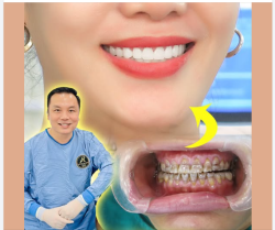 Tiêu Chuẩn Về Nụ Cười Đẹp: Từ Truyền Thống Đến Hiện Đại