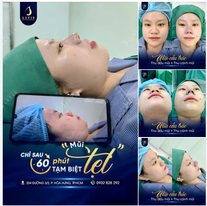 Tạm biệt nỗi lo mũi tẹt, góc nghiêng chuẩn tỉ lệ vàng nay đã hiện rõ chỉ sau một ca thực hiện!