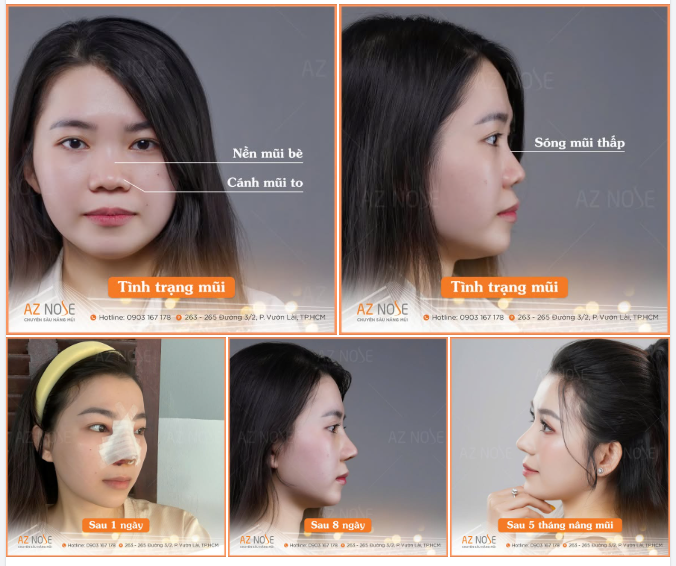 Là nhân viên spa, khách hàng mong muốn cải thiện nền mũi thấp, cánh mũi khá to nhưng vẫn ưu tiên dáng mũi tự nhiên, hợp mặt.