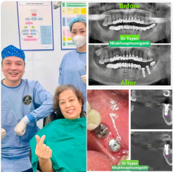 Thay thế cầu răng truyền thống bằng trụ Implant với kỹ thuật cấy ghép không lật vạt, xâm lấn tối thiểu: không sưng, không đau, không chảy máu …