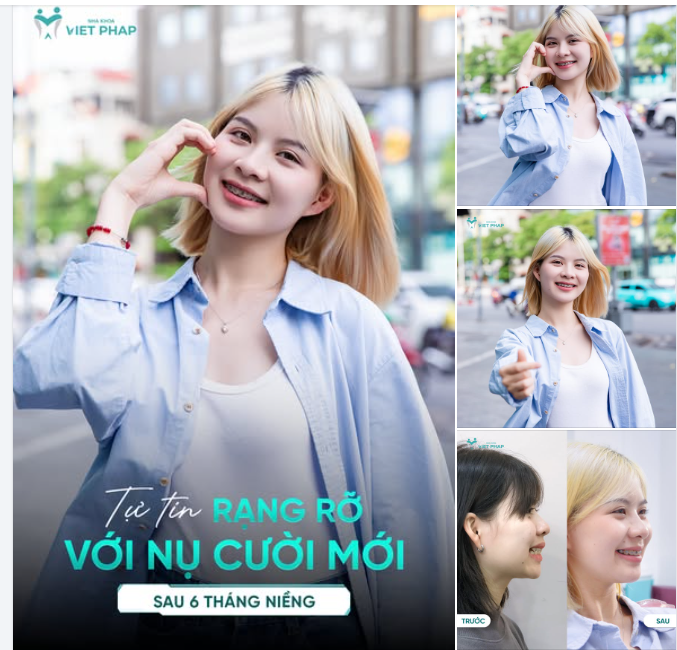 TỰ TIN CƯỜI RẠNG RỠ VỚI NỤ CƯỜI MỚI