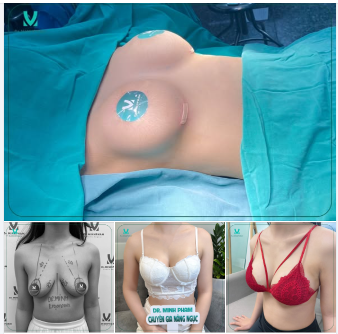 NHÌN LẠI QUÁ TRÌNH THAY ĐỔI SAU 2 THÁNG NÂNG NGỰC