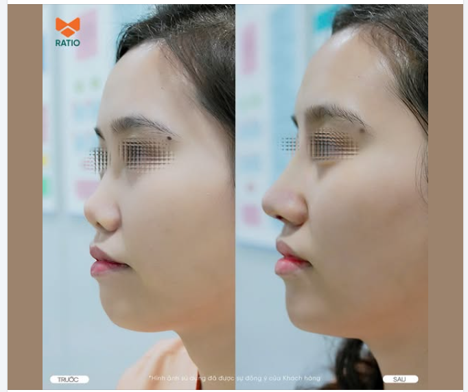 Tiêu chuẩn của một ca phẫu thuật nâng mũi thành công không chỉ dừng lại trong phòng mổ