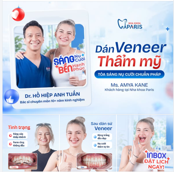 TỎA SÁNG NỤ CƯỜI CHUẨN PHÁP CÙNG DÁN SỨ VENEER THẨM MỸ!