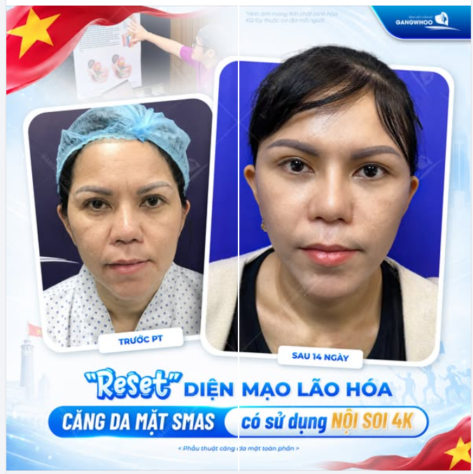 “RESET” DIỆN MẠO LÃO HÓA SAU 1 LẦN THỰC HIỆN