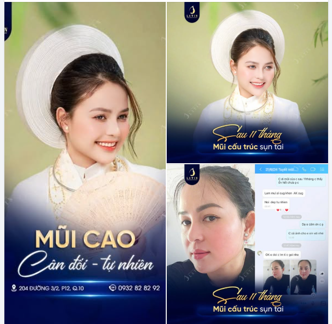 Một dáng mũi đẹp lâu dài không chỉ nằm ở khoảnh khắc vừa vào phom, mà còn ở cách đường nét dần ổn định, mềm hơn và hòa vào tổng thể gương mặt theo thời gian.