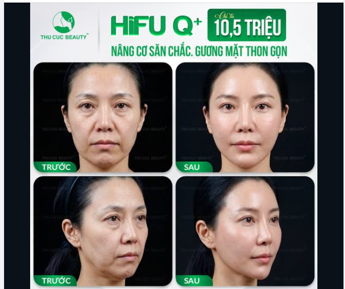 SIẾT GỌN VIỀN HÀM, KIẾN TẠO GƯƠNG MẶT THON GỌN VỚI CÔNG NGHỆ HIFU Q+