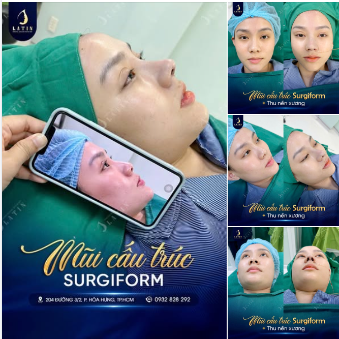 Một dáng m.ũ.i thiếu thanh thoát đôi khi không chỉ nằm ở phần sống thấp, mà còn đến từ nền xương bè khiến sống mũi bị chìm, khoảng cách hai mắt nhìn xa và gương mặt bị phẳng lì.