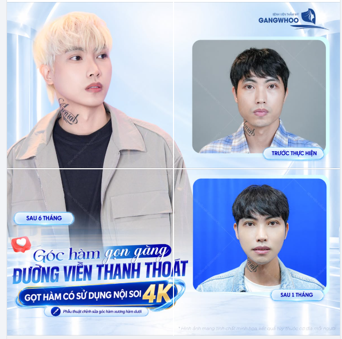 GÓC HÀM GỌN HƠN – ĐƯỜNG VIỀN THANH THOÁT - GỌT HÀM CÓ SỬ DỤNG NỘI SOI 4K
