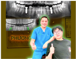Implant có bền suốt đời không, có phải thay sau vài năm không?