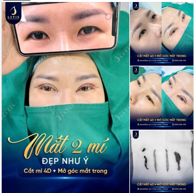 Một đôi mắt trông ngắn và thiếu điểm nhấn đôi khi không chỉ do chưa có nếp mí rõ, mà còn đến từ nếp rẻ quạt che góc mắt trong, khiến chiều ngang mắt bị thu hẹp.
