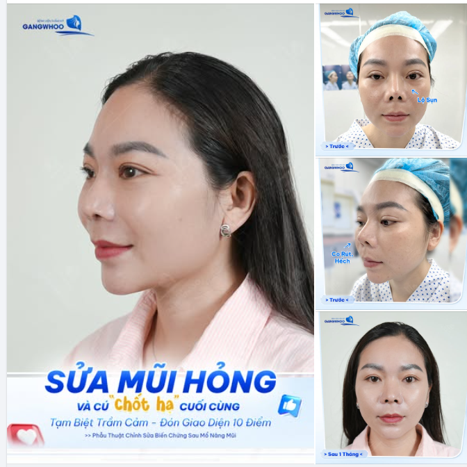 SỬA MŨI HỎNG - THAY ĐỔI DÁNG MŨI, TÌM LẠI SỰ TỰ TIN