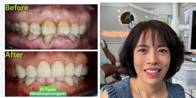 Răng thật ảnh hưởng đến đến răng sứ