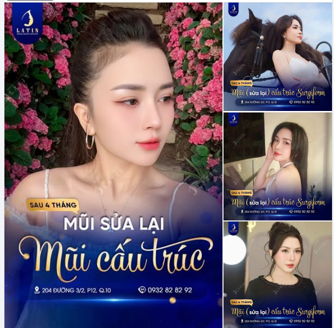Một dáng mũi đã từng can thiệp nhưng chưa hài hòa thường không thể chỉ xử lý bằng cách nâng sống cao hơn.
