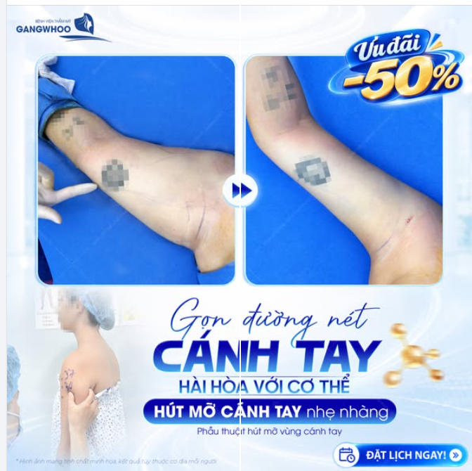 GỌN ĐƯỜNG NÉT CÁNH TAY HÀI HÒA VỚI CƠ THỂ