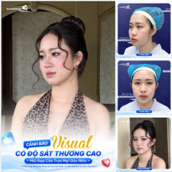 CẢNH BÁO: VISUAL CÓ ĐỘ SÁT THƯƠNG CAO